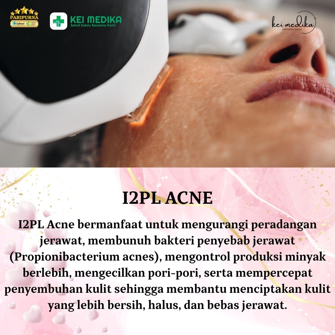 I2PL ACNE