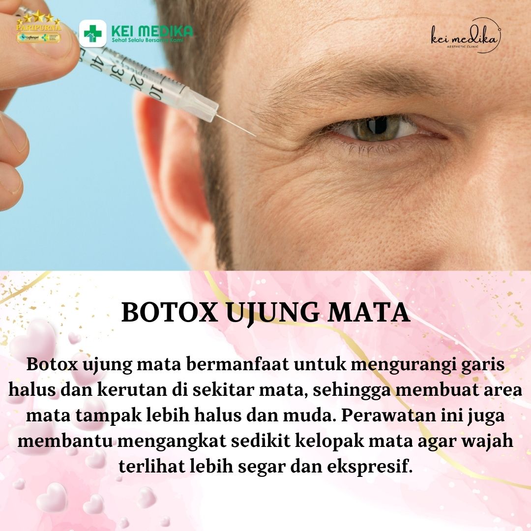 BOTOX UJUNG MATA