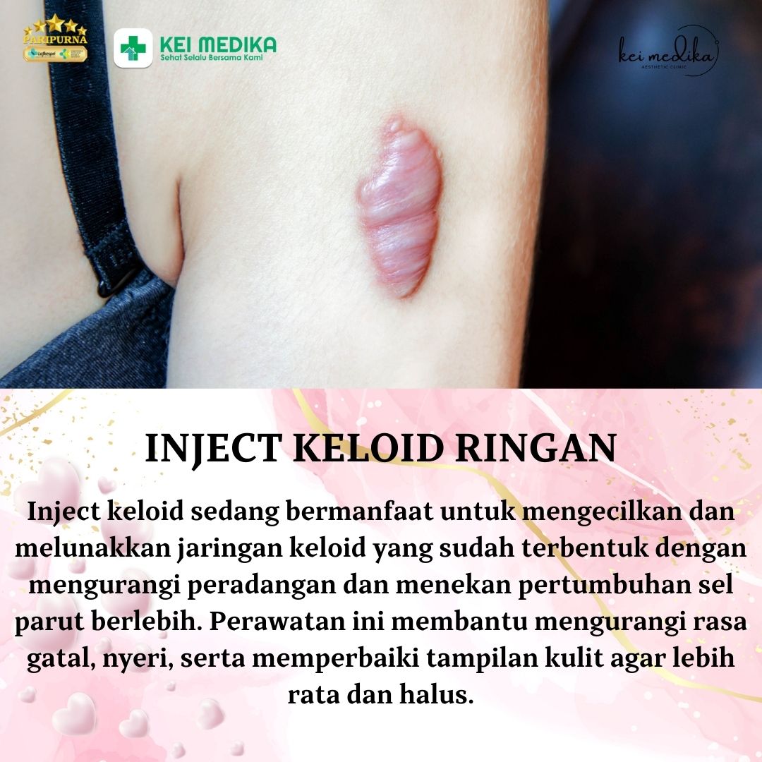 INJECT KELOID SEDANG