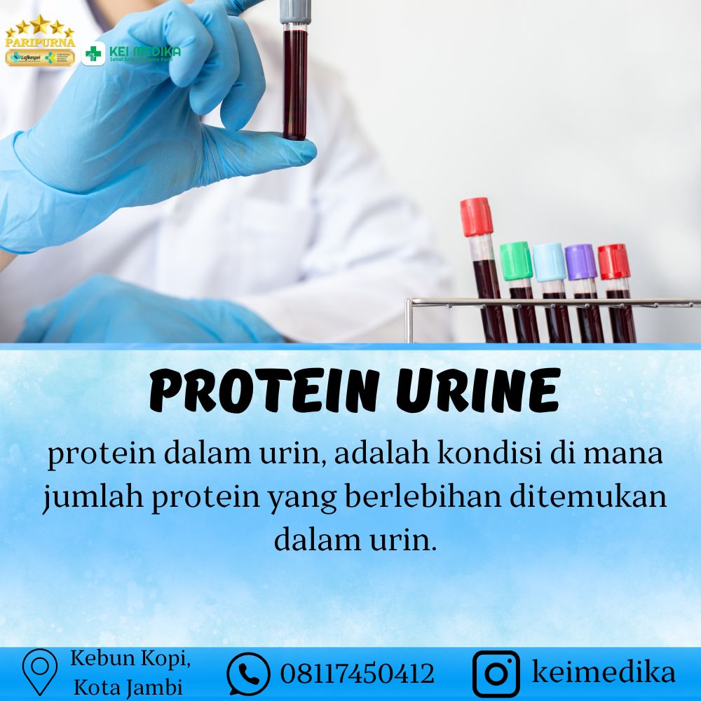 PROTEIN URINE 