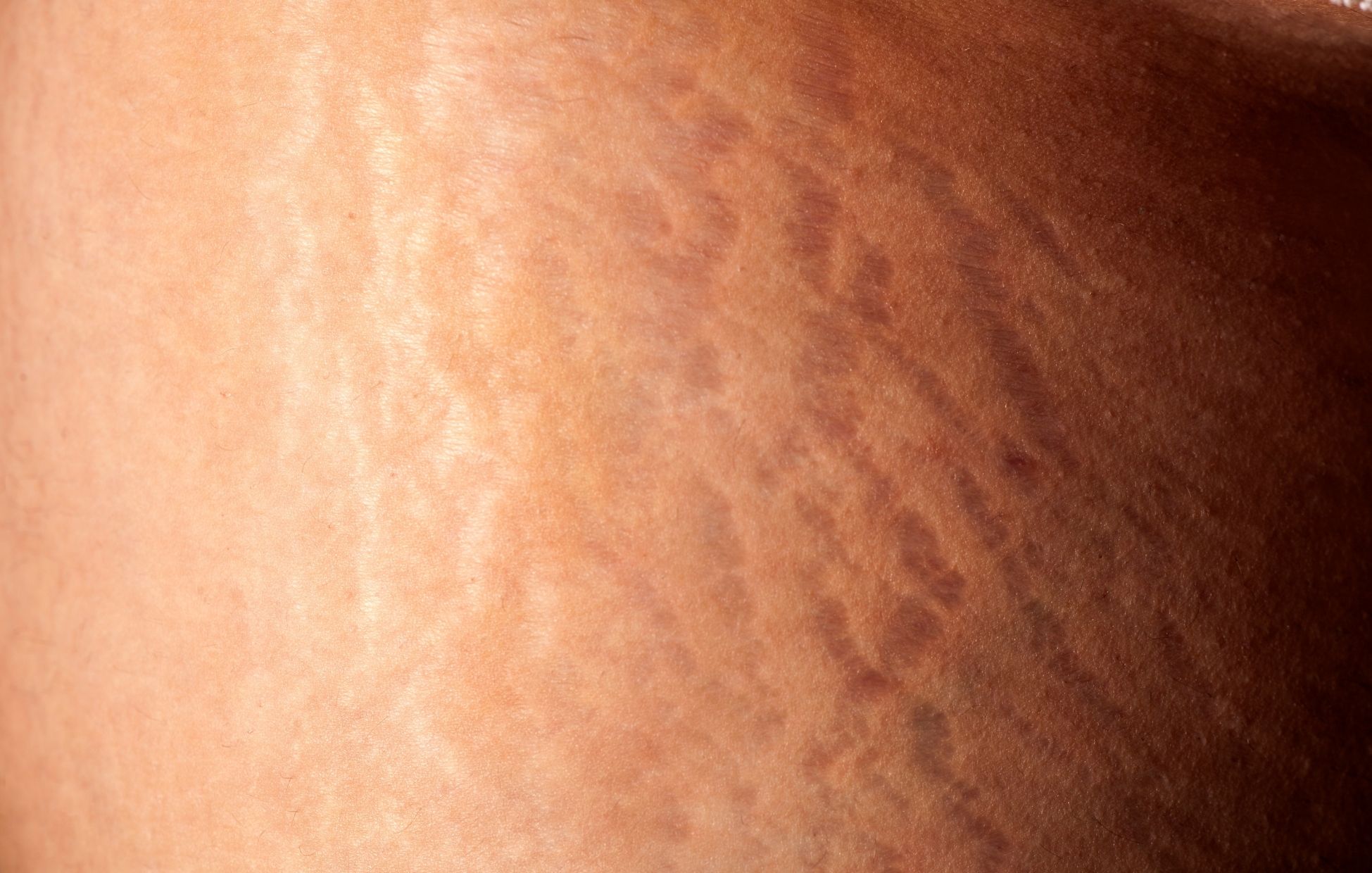   Kiat Menghilangkan Stretch Mark