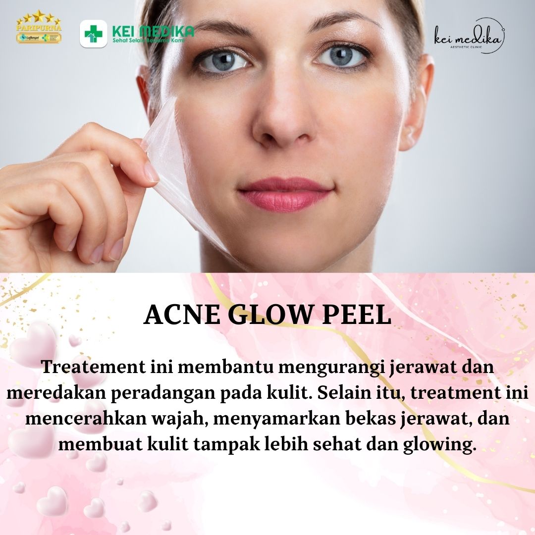 ACNE GLOW PEEL  