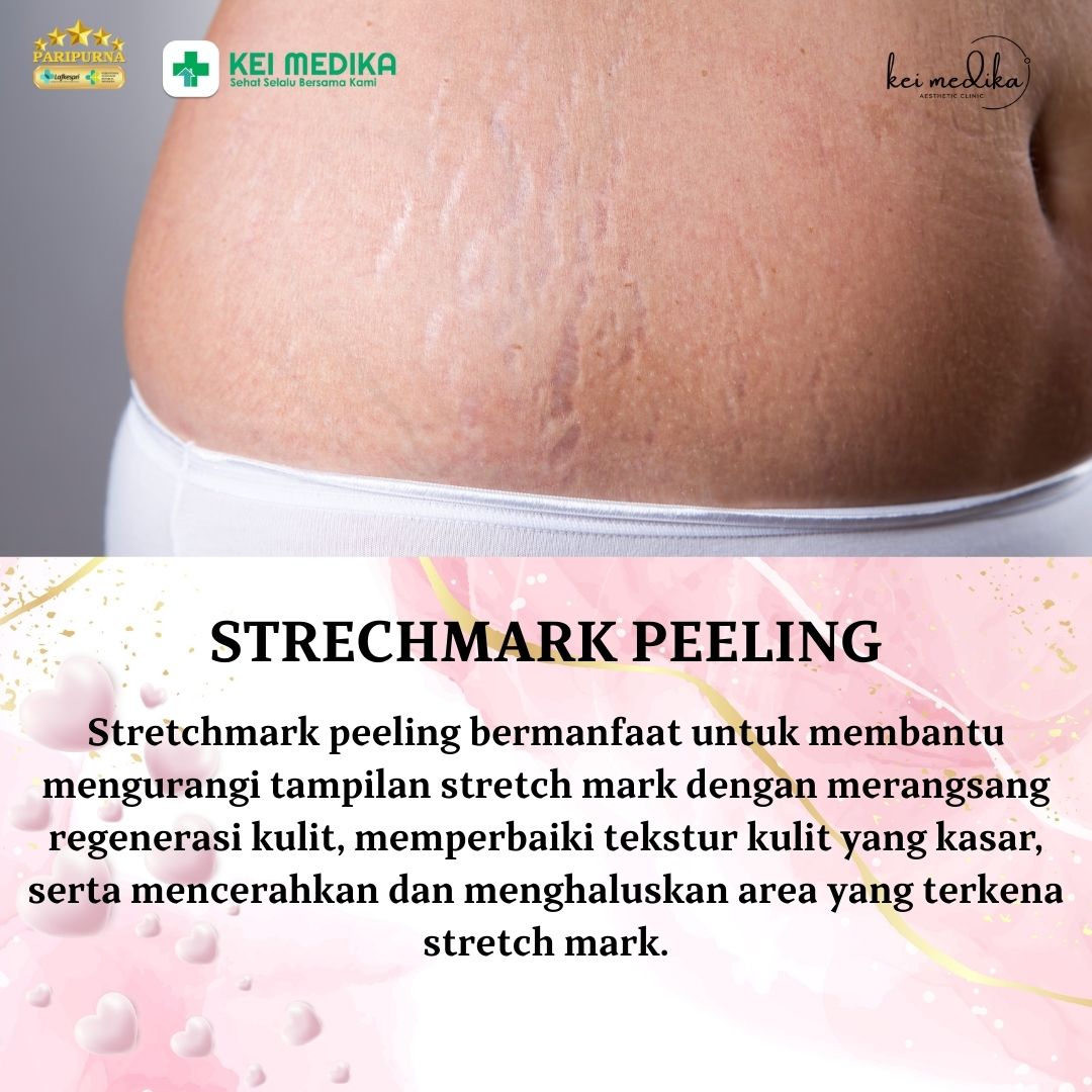 STRECHMARK PEELING
