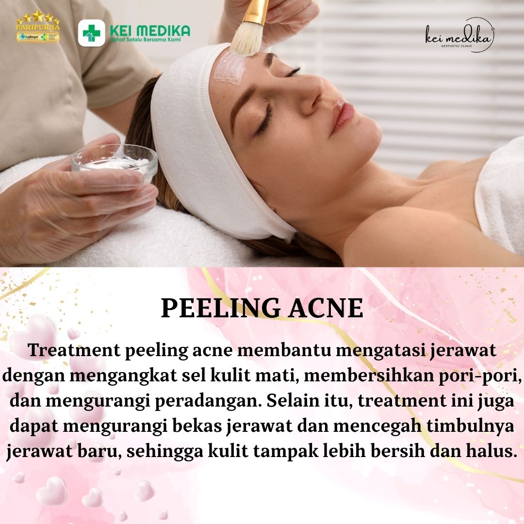 PEELING ACNE