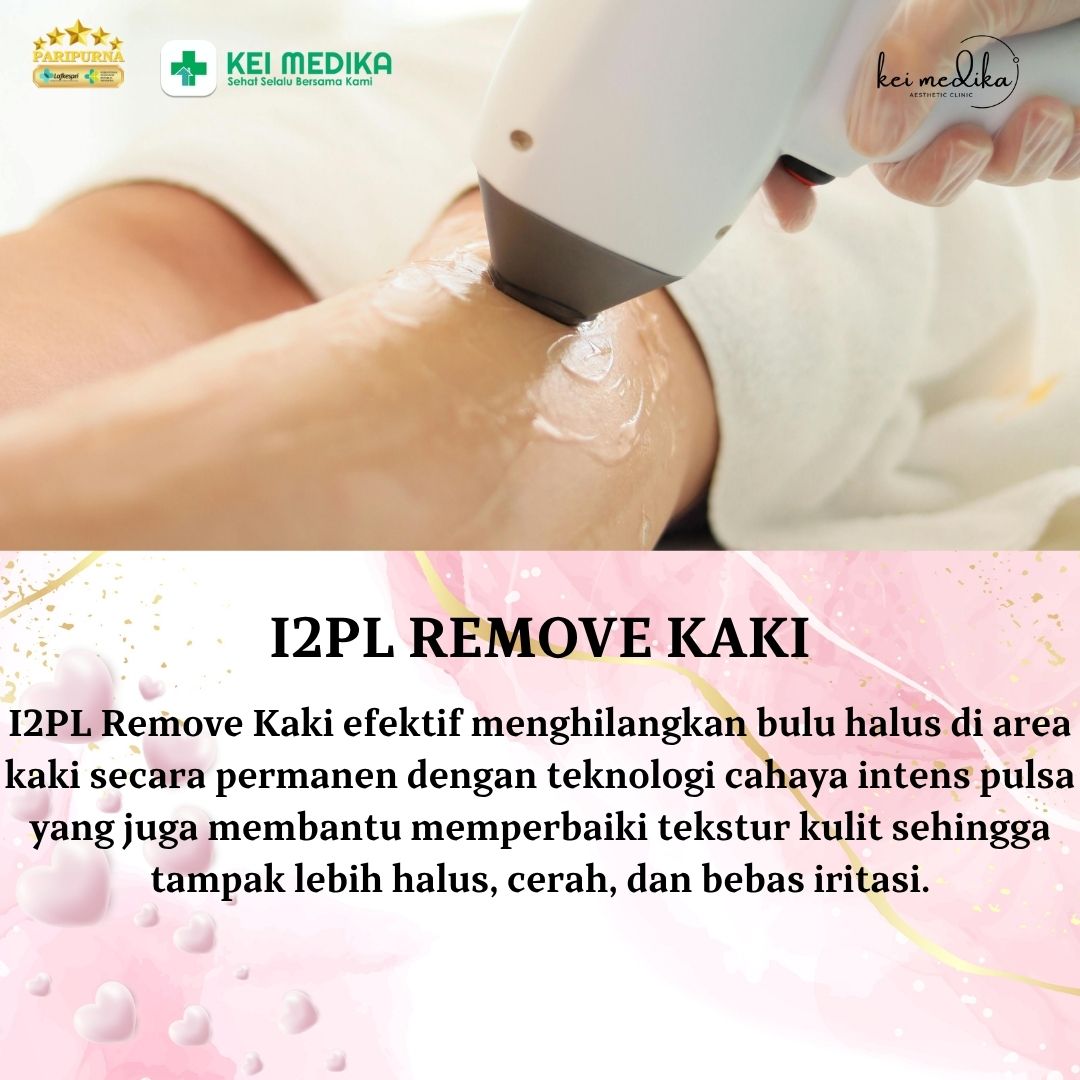I2PL REMOVAL KAKI