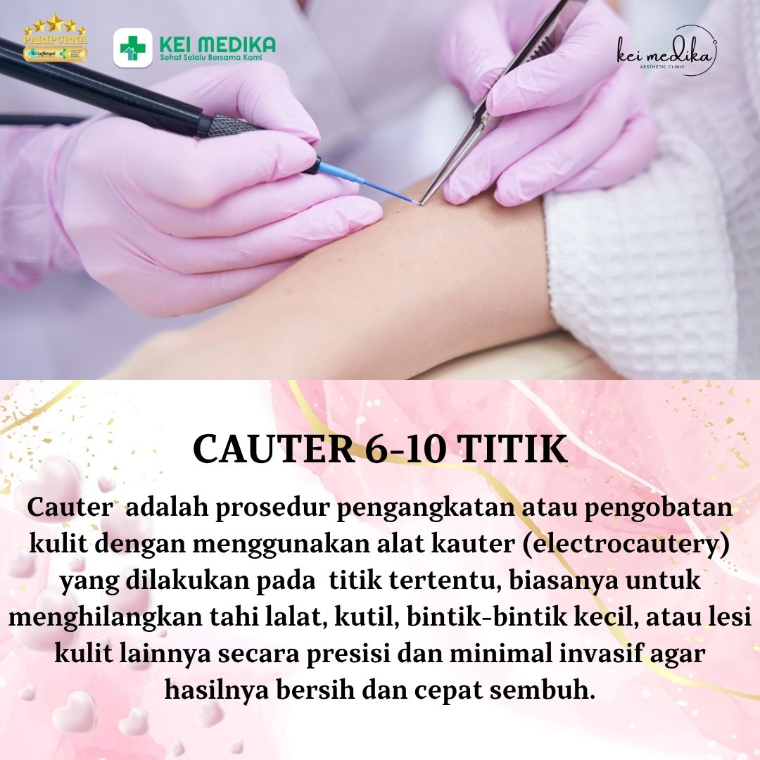 CAUTER 6-10 TITIK
