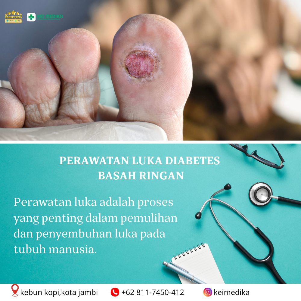  PERAWATAN LUKA DIABETES BASAH RINGAN