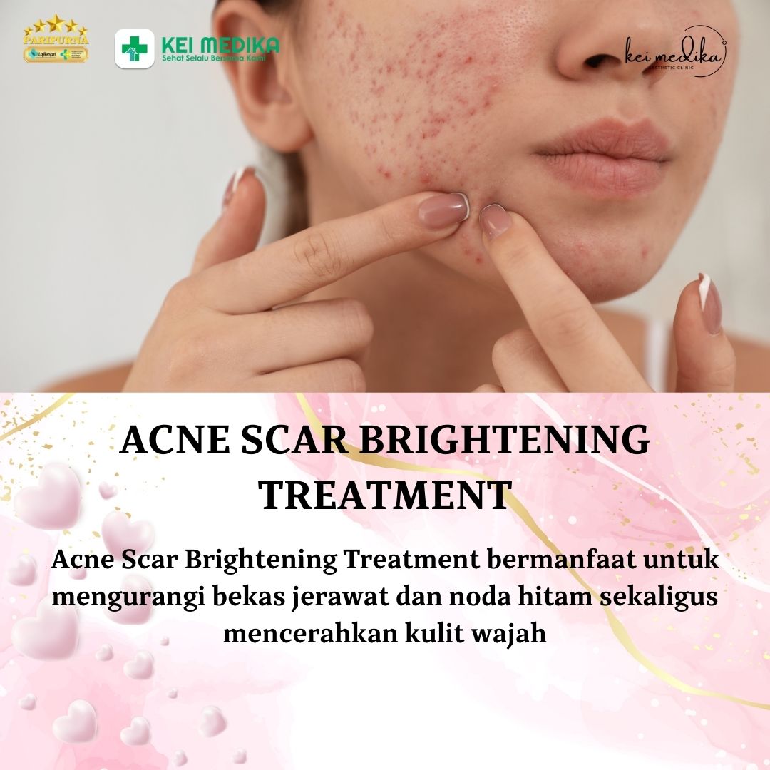 ACNE SCAR BRIGHTENING  TREATMENT 