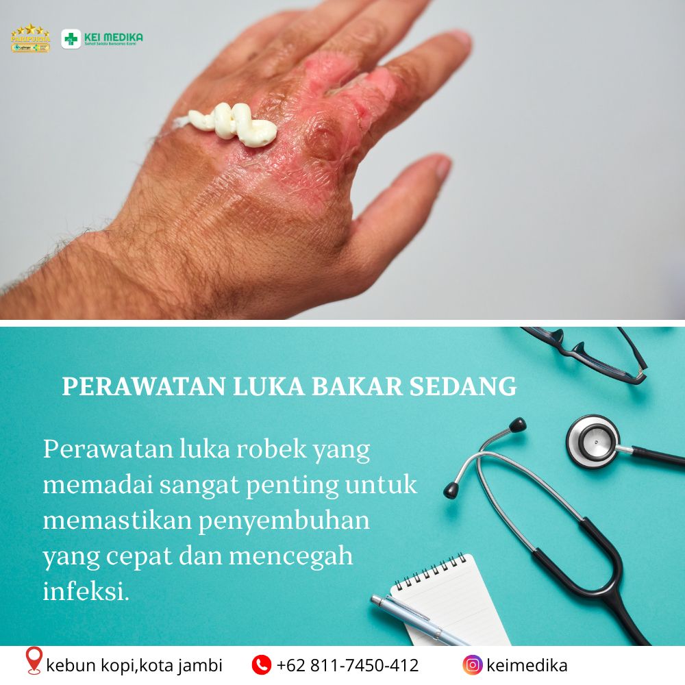 PERAWATAN LUKA BAKAR SEDANG DENGAN BAHAN ( KLINIK )