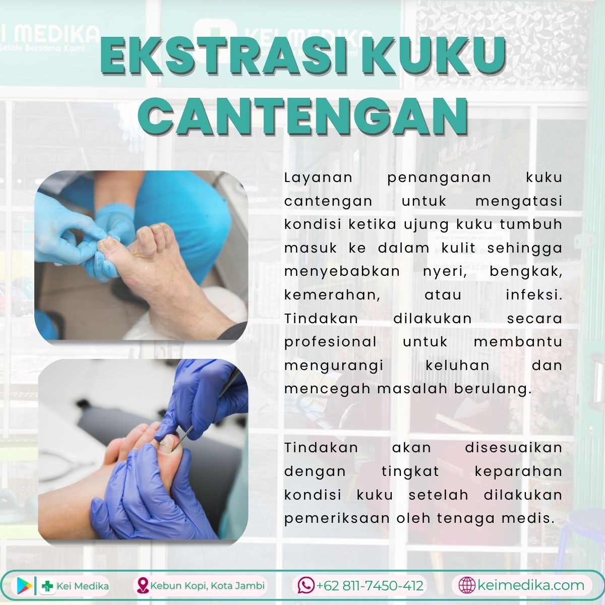 Penanganan Cantengan (Onychocryptosis)