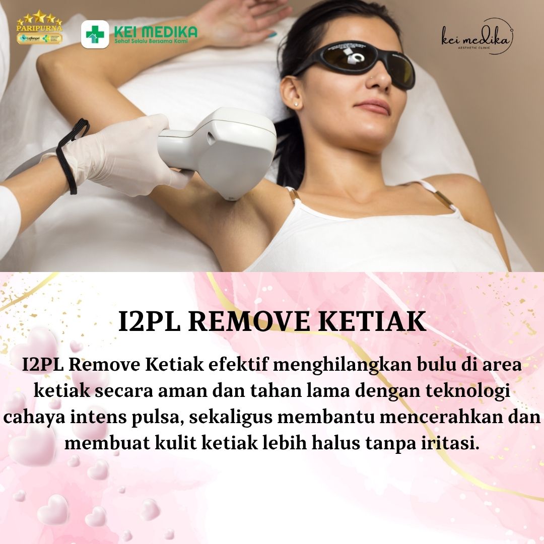 I2PL REMOVAL KETIAK