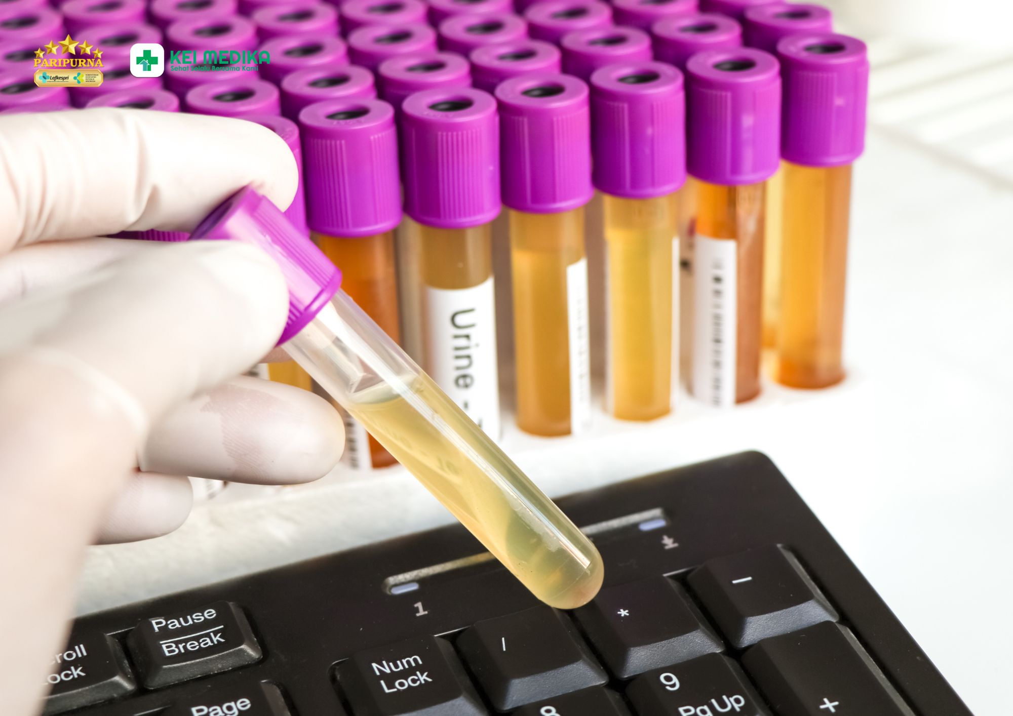 Warna Urine Berubah Menjadi Pekat, Kapan Harus Diperiksa?