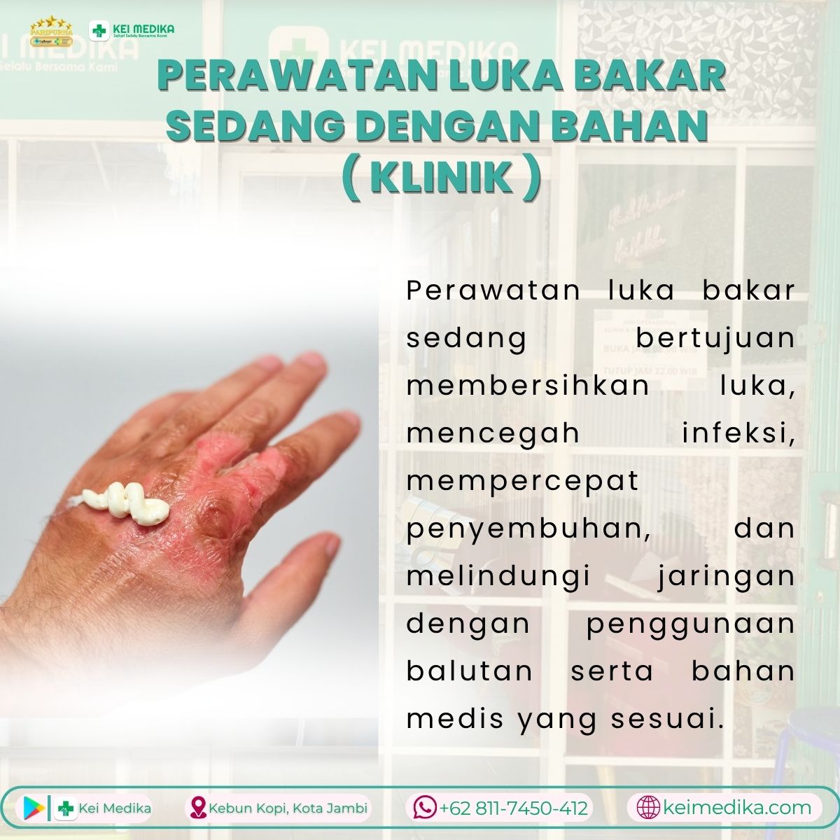 PERAWATAN LUKA BAKAR SEDANG DENGAN BAHAN ( KLINIK )