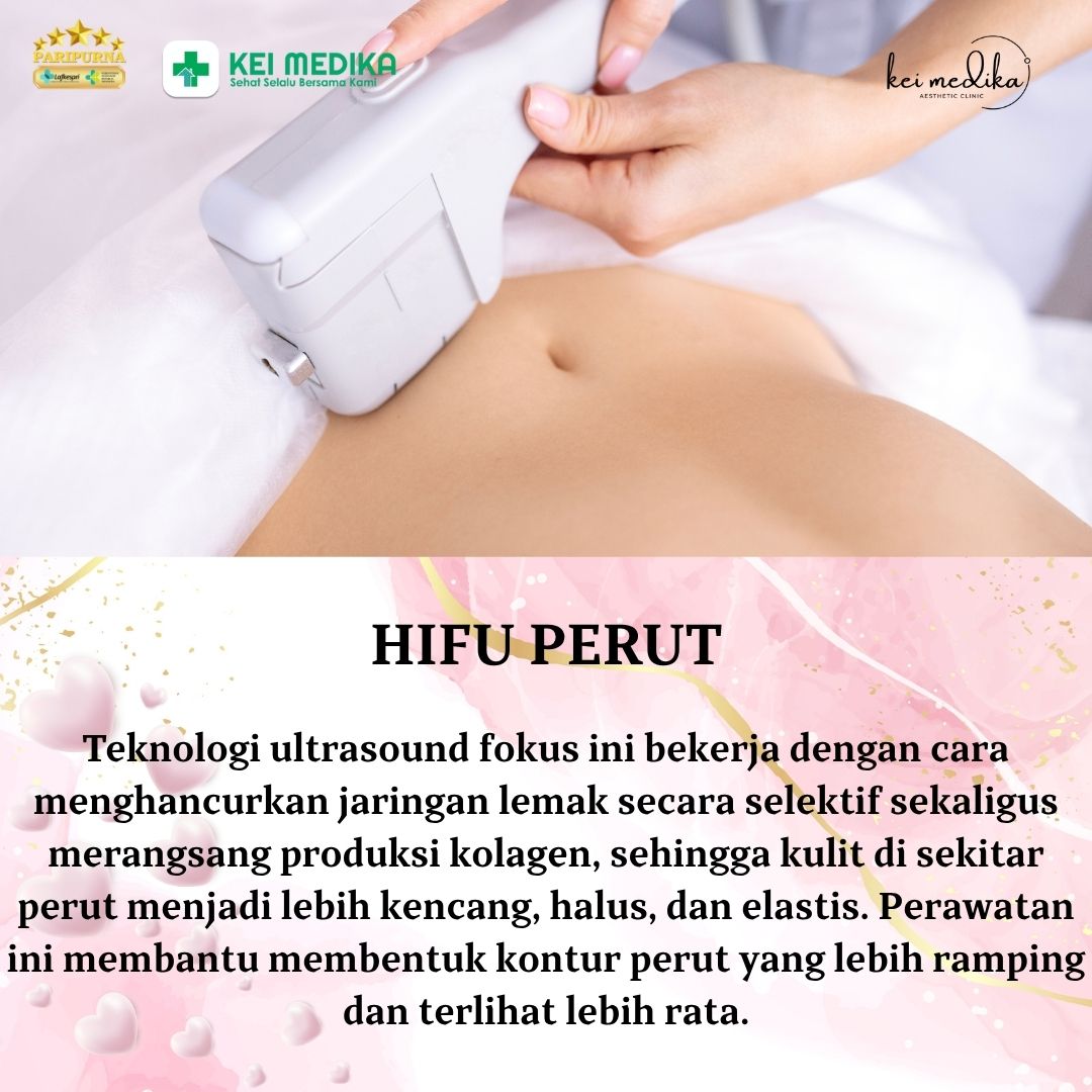 HIFU PERUT