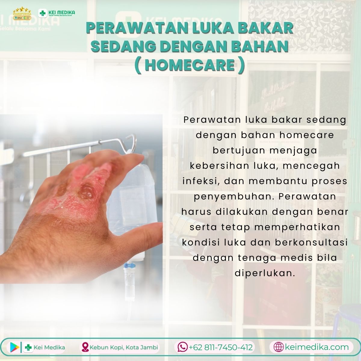 PERAWATAN LUKA BAKAR BESAR DENGAN BAHAN ( HOMECARE )