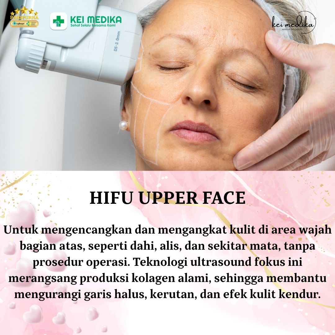 HIFU UPPER FACE